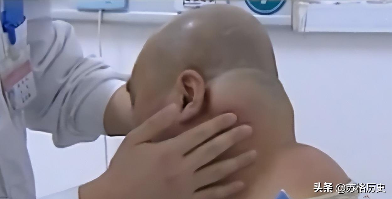 喝了40年酒结果变成河马脖,喝白酒脖子变成河马脖