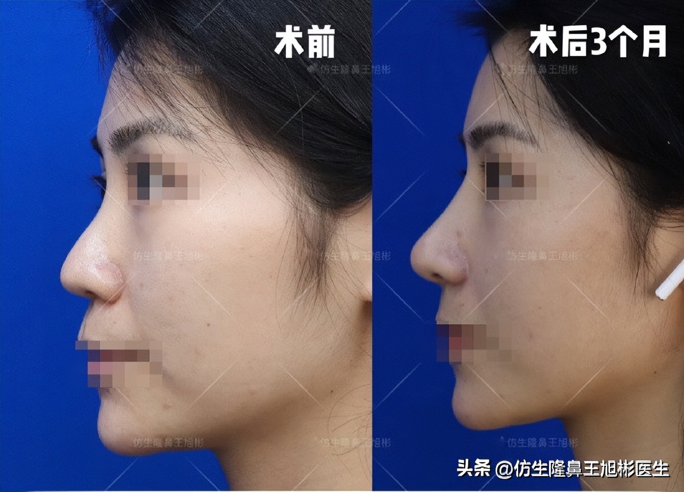 大鼻头能做直鼻微翘吗,可以只做鼻头缩小术吗