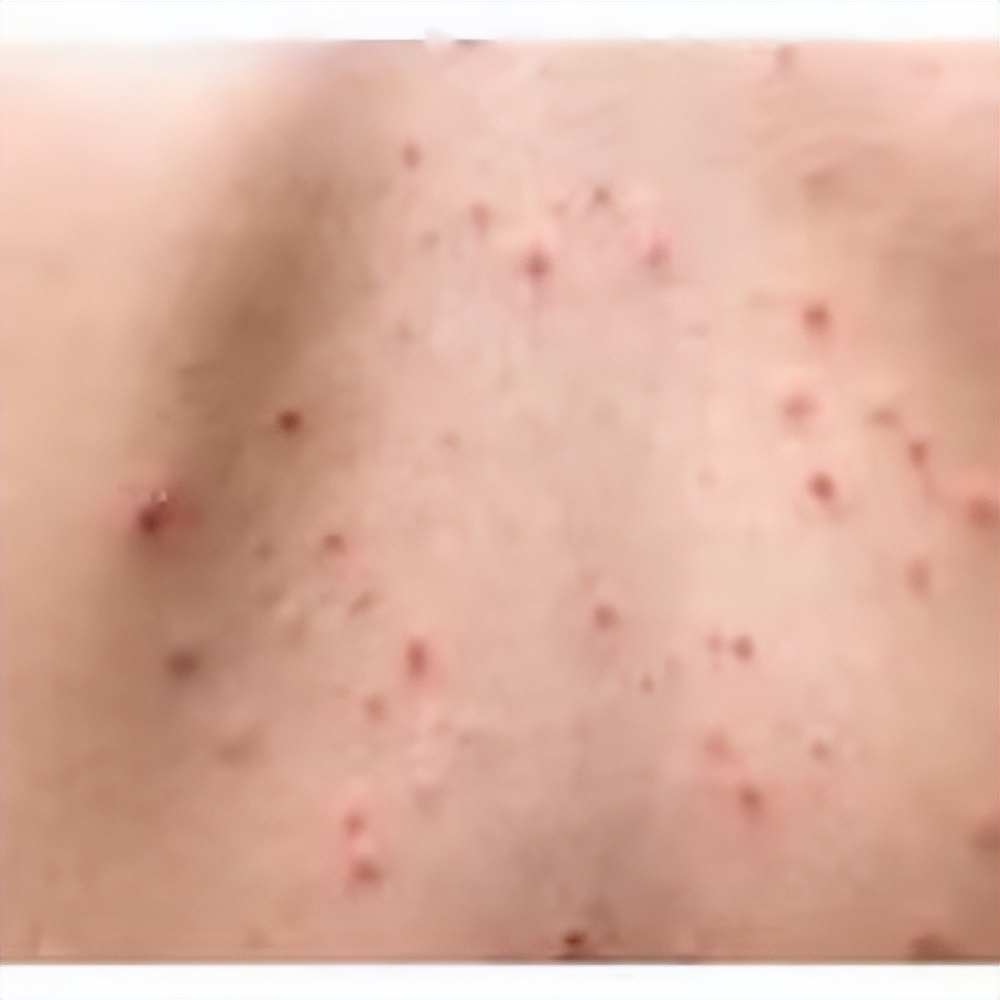 背部长痘按摩哪里,背部长痘对应五脏六腑