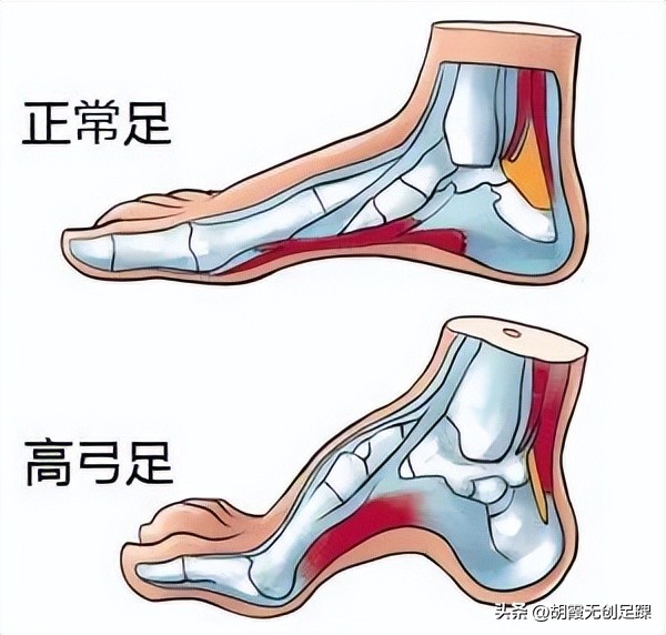 儿童足内翻最快的恢复方法,小儿足内翻怎么判断