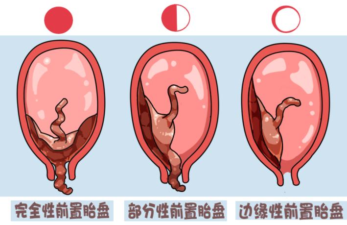 孕妈睡觉不老实怎么办,家有孕妇者一定要注意这六点