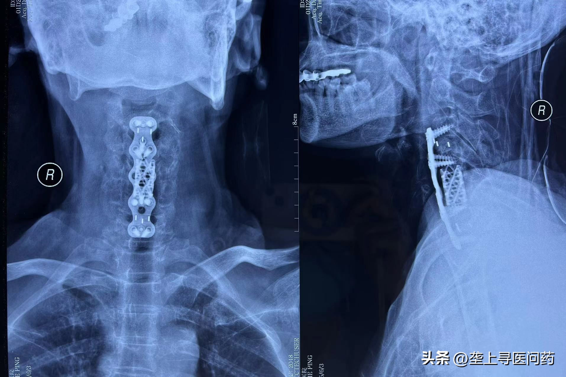 颈部脊髓损伤的上肢康复训练,颈部脊髓损伤病人康复