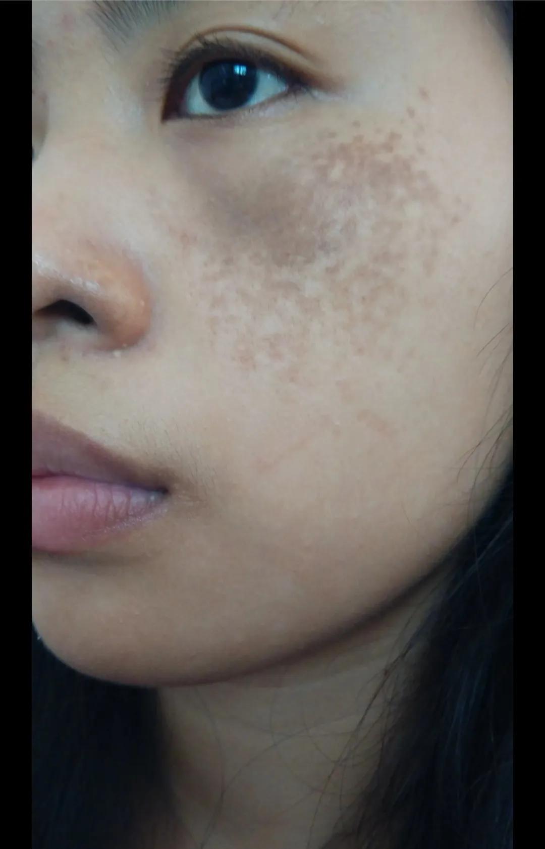 40多岁脸上长黑点是什么斑,40岁脸上长斑用什么护肤品