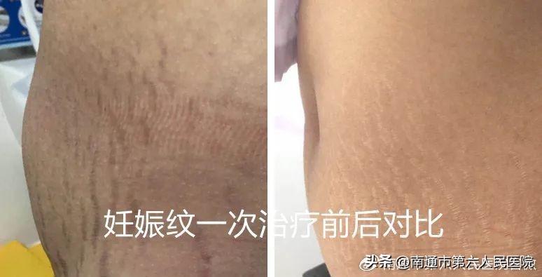 冰点脱毛除唇毛,冰点脱毛能根除体毛吗