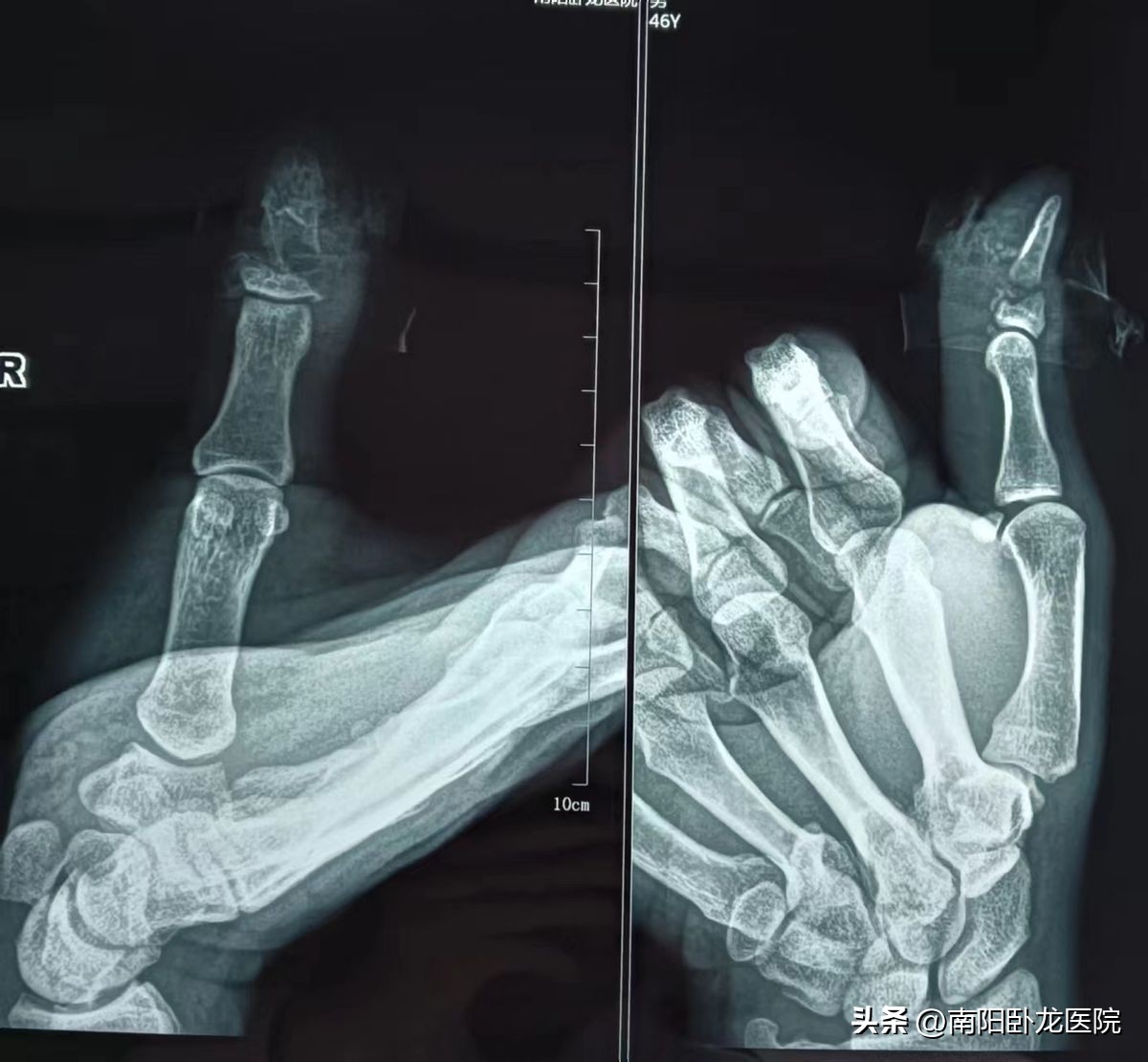 灞曠瓔缁,灞曠瓔