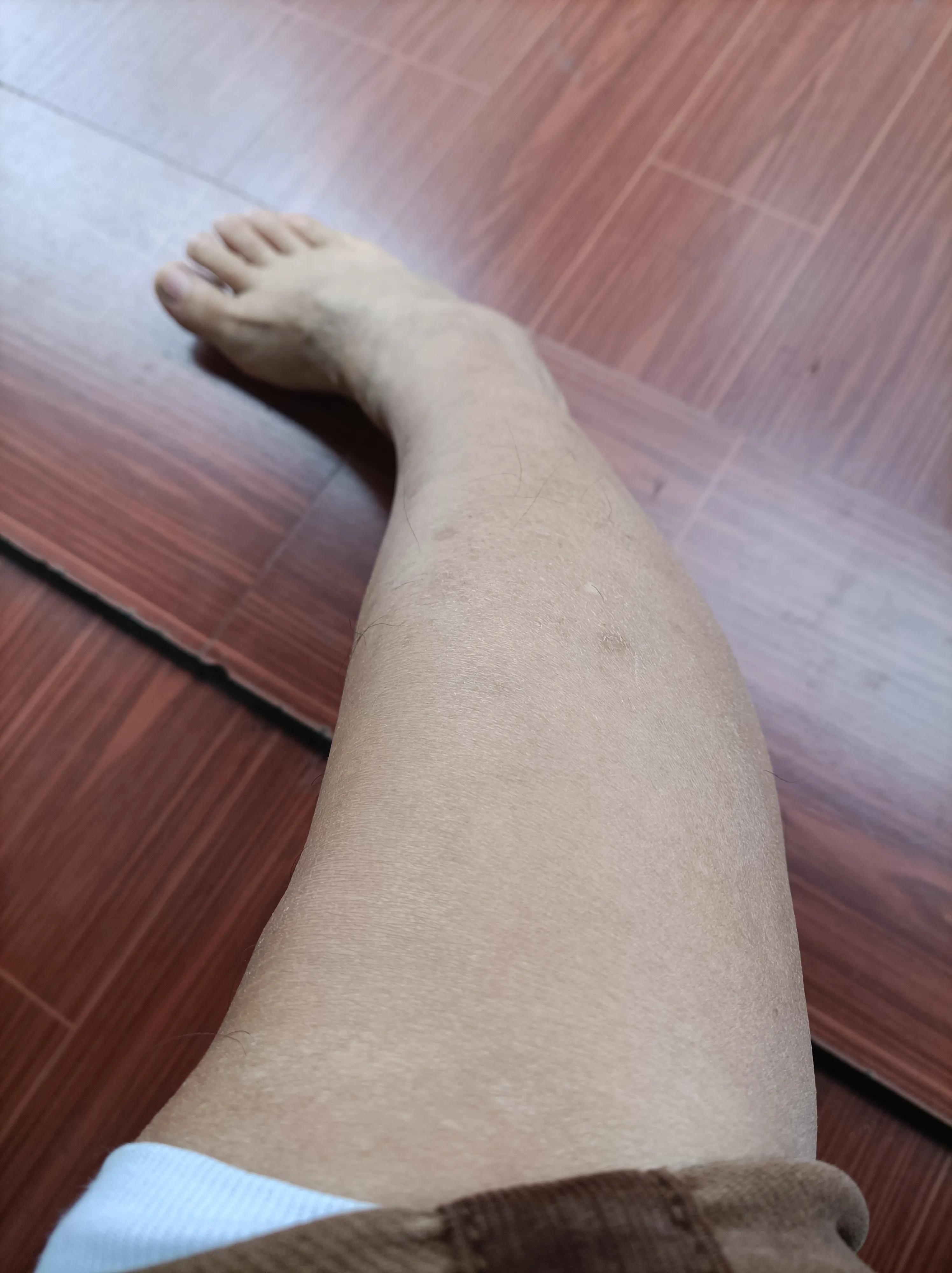 猪油烫伤急救方法,猪油烫伤双脚后用什么药好得快