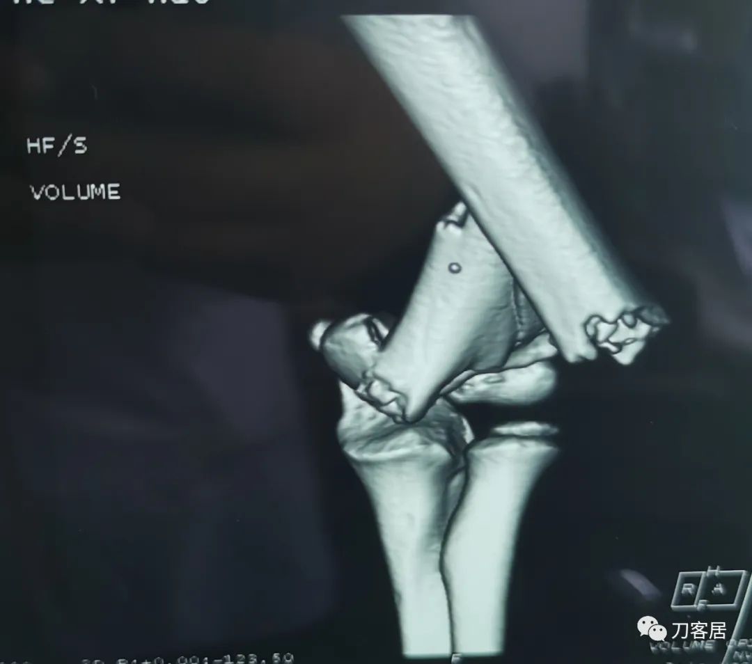 孩子胳膊摔伤肿了不能弯曲一直疼,9岁男孩摔倒手臂痛怎么办