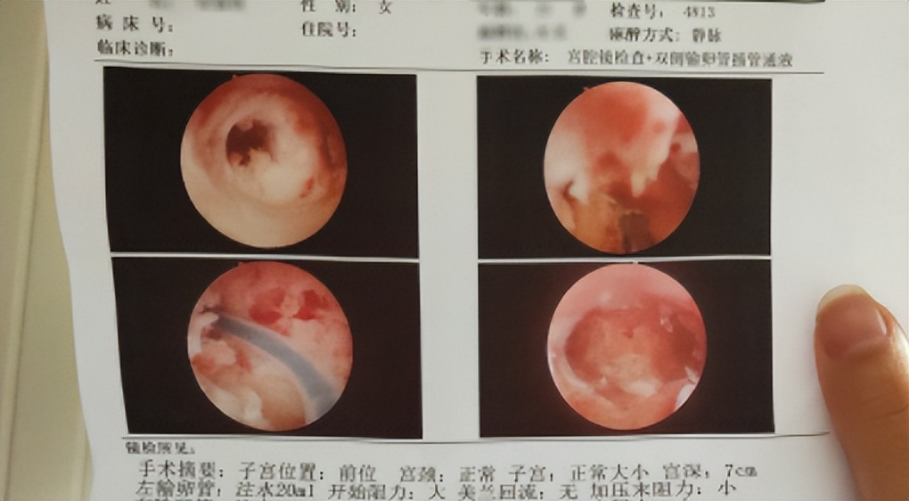 有流产历史再次怀孕生化,怀孕两次生化一次宫外孕