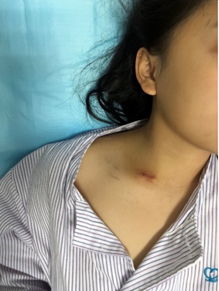 脖子歪睡觉能扶正吗,歪头多久可以矫正