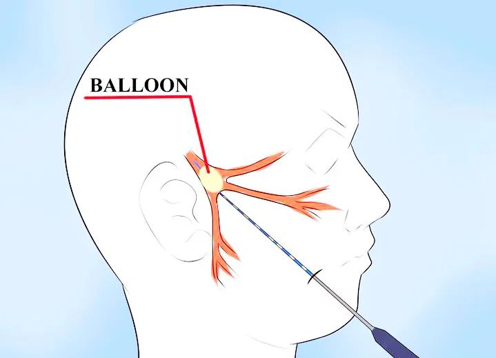 卡马西平治疗三叉神经痛多久停药,三叉神经痛吃什么药能彻底治愈