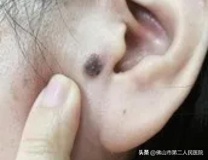 年轻歌手得黑色素瘤去世,歌手黑痣和黑色素瘤的区别