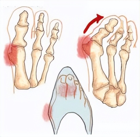 拇外翻会引起脚趾疼吗女性,为什么女人脚拇外翻的比较多