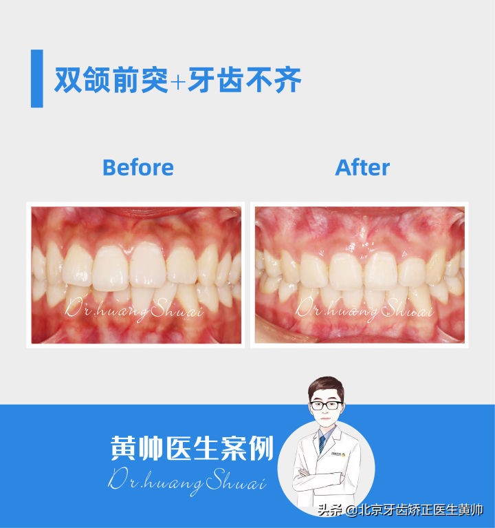 嘴凸的人怎么笑起来好看,嘴型比较凸的人怎么改善