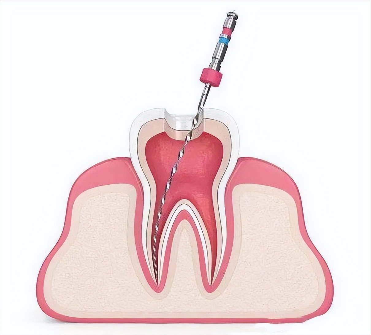 补的牙咬东西酸怎么办,补好的牙一按就疼