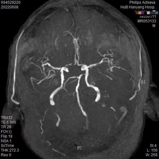 如何摆脱头晕眩晕的痛苦,眩晕一招搞定头晕