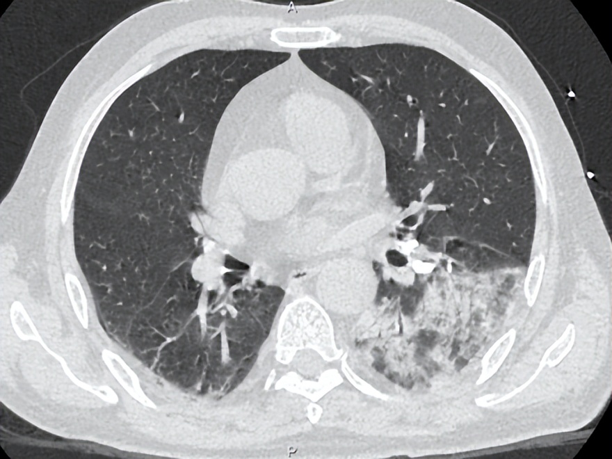 发热十多天了输液吃药还是发热,脓毒症高烧不退