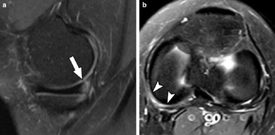 查半月板是拍片还是磁共振,半月板核磁共振影像诊断