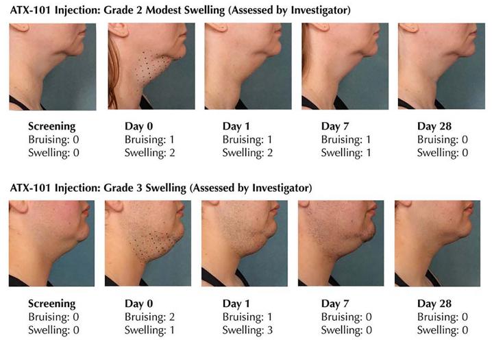 整形医生都不碰的医美项目溶脂针,最强的溶脂针