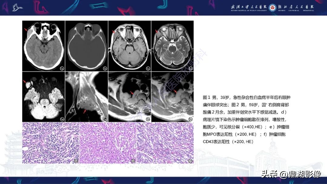 阴道肉瘤症状,阴道肉瘤的早期症状