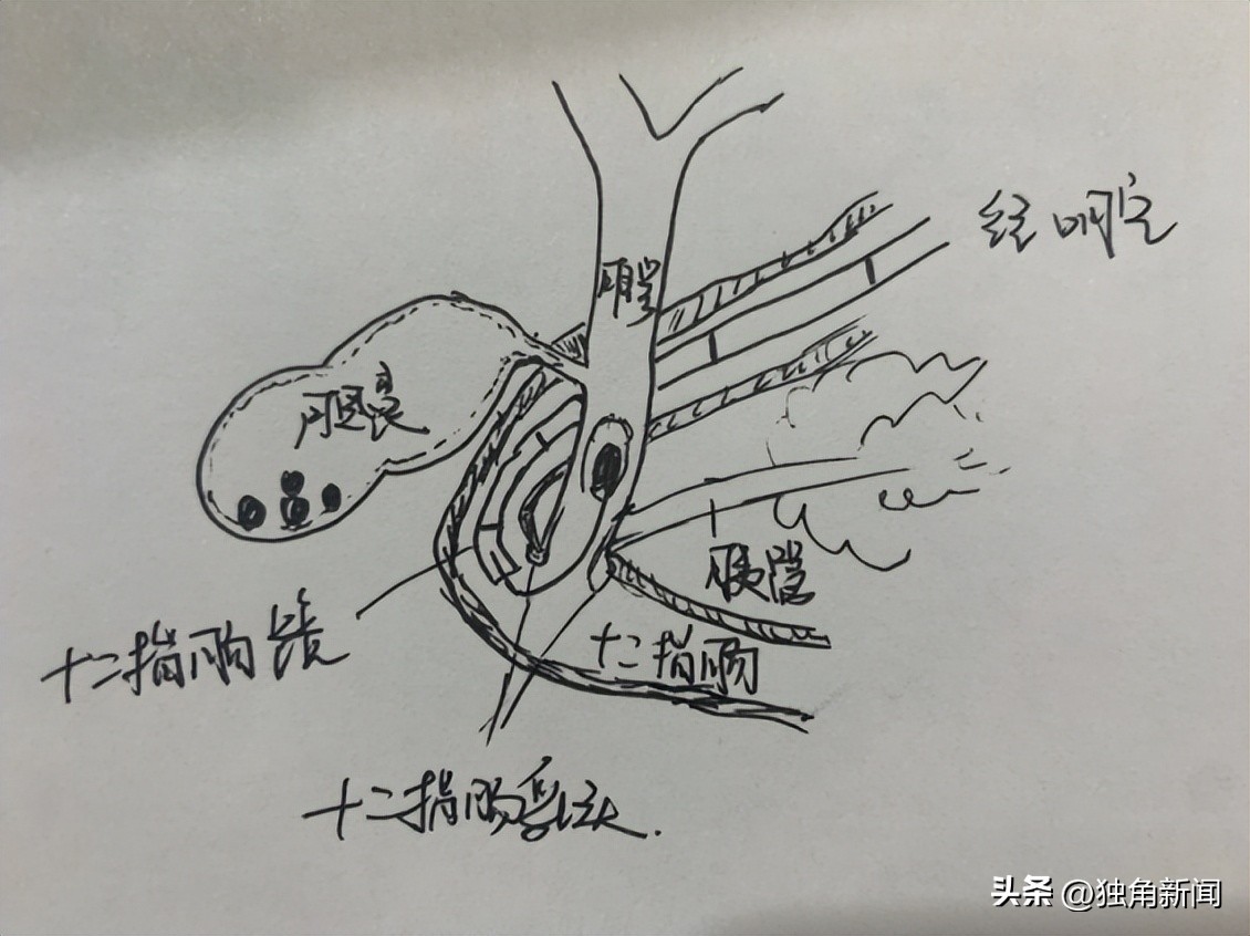 胆道微创,胆结石微创手术三个孔