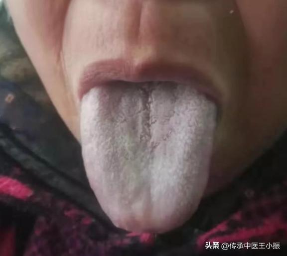 寒热舌诊图解大全,如何看舌象判断疾病准确用药