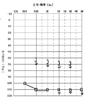 突发性耳聋的原因和症状,突发性耳聋的表现及治疗原则是