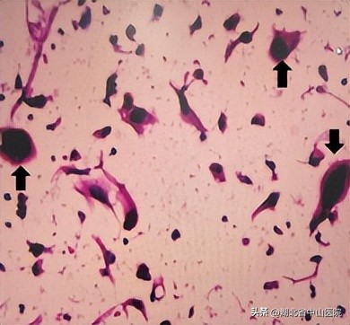 宫颈癌筛查TCT、HPV傻傻分不清，病理科为您来揭秘