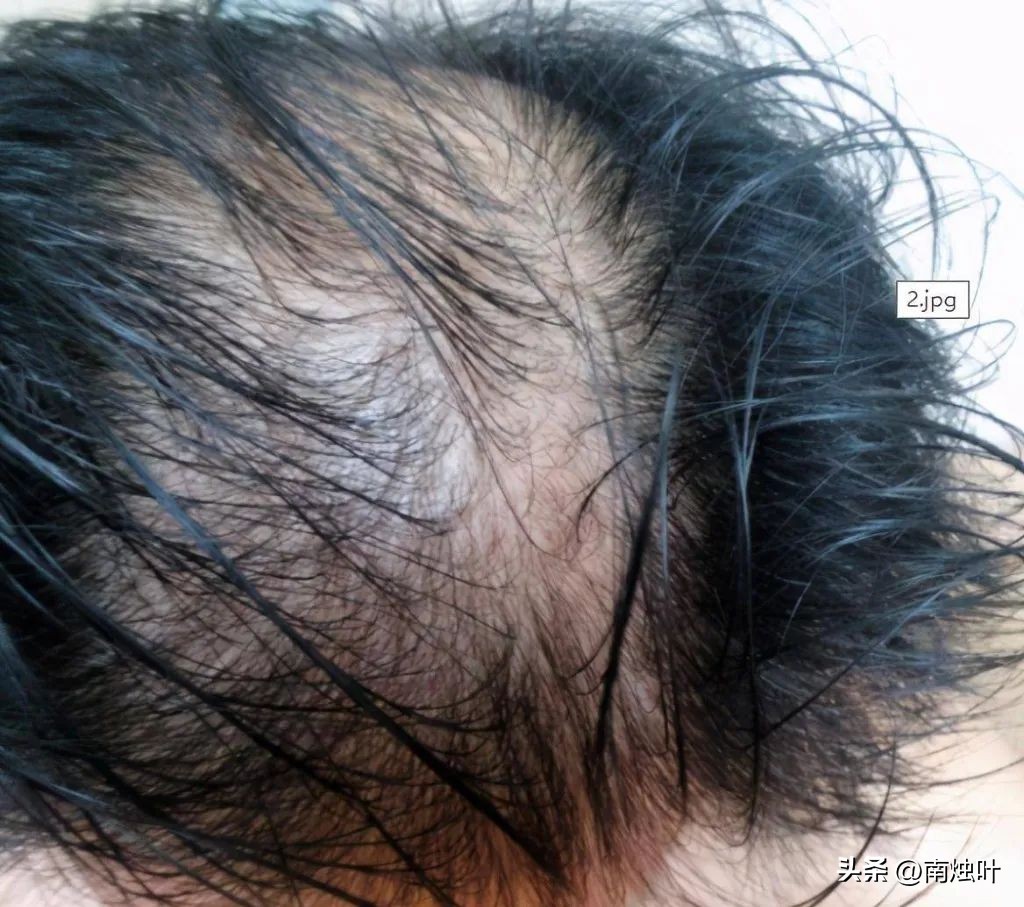 头油头痒头屑掉头发怎么治疗,头屑多头皮痒油头有什么好妙招