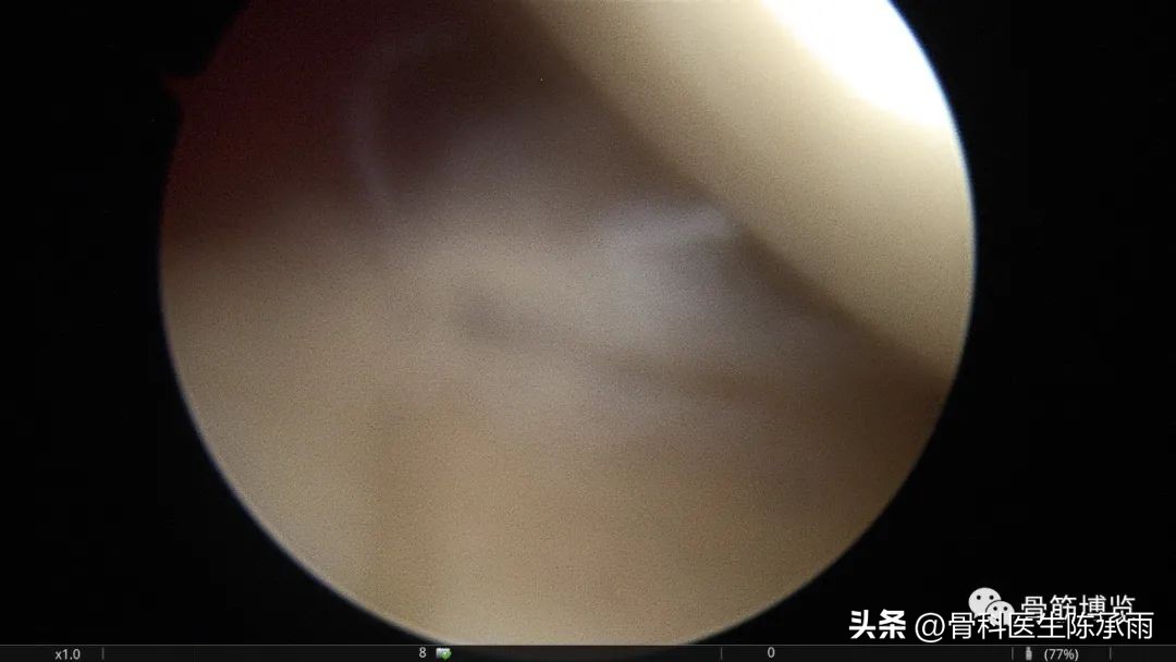 肱二头肌长头肌腱断裂超声报告,上臂肱二头肌