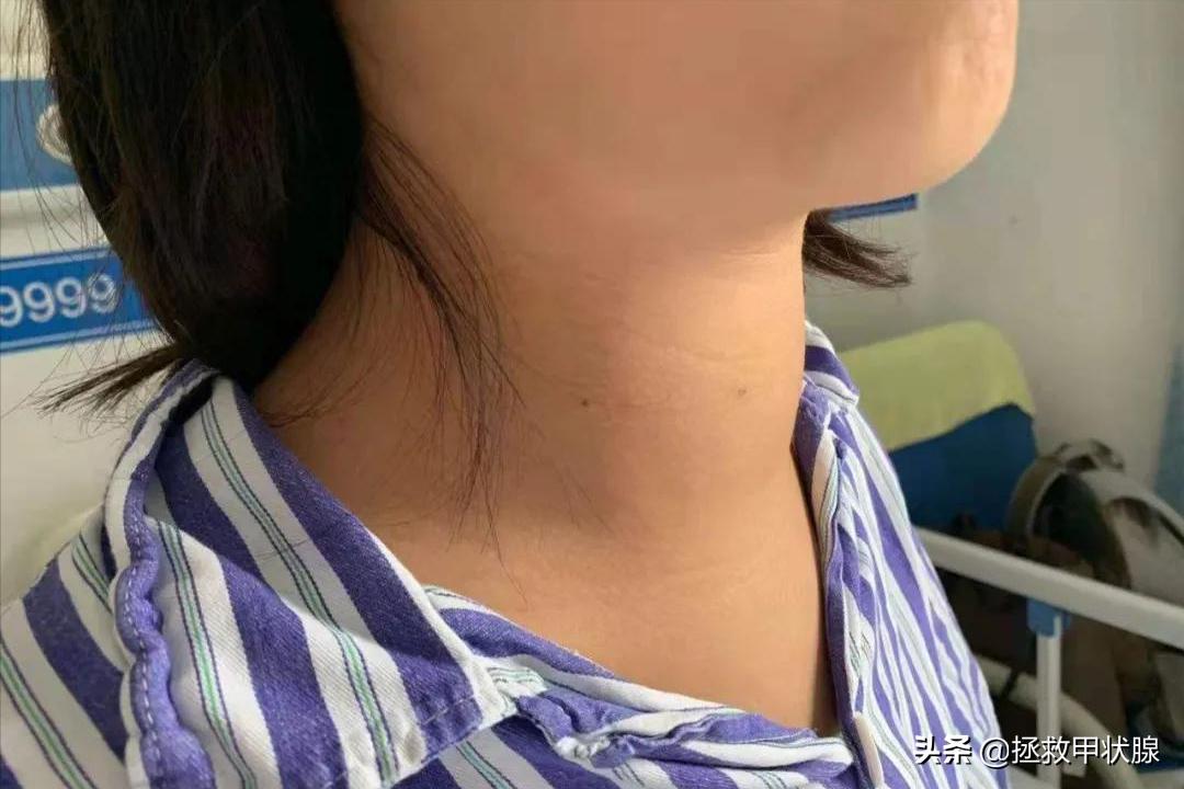 妙用一个古方，4个月时间，甲状腺结节一次治愈！无复发