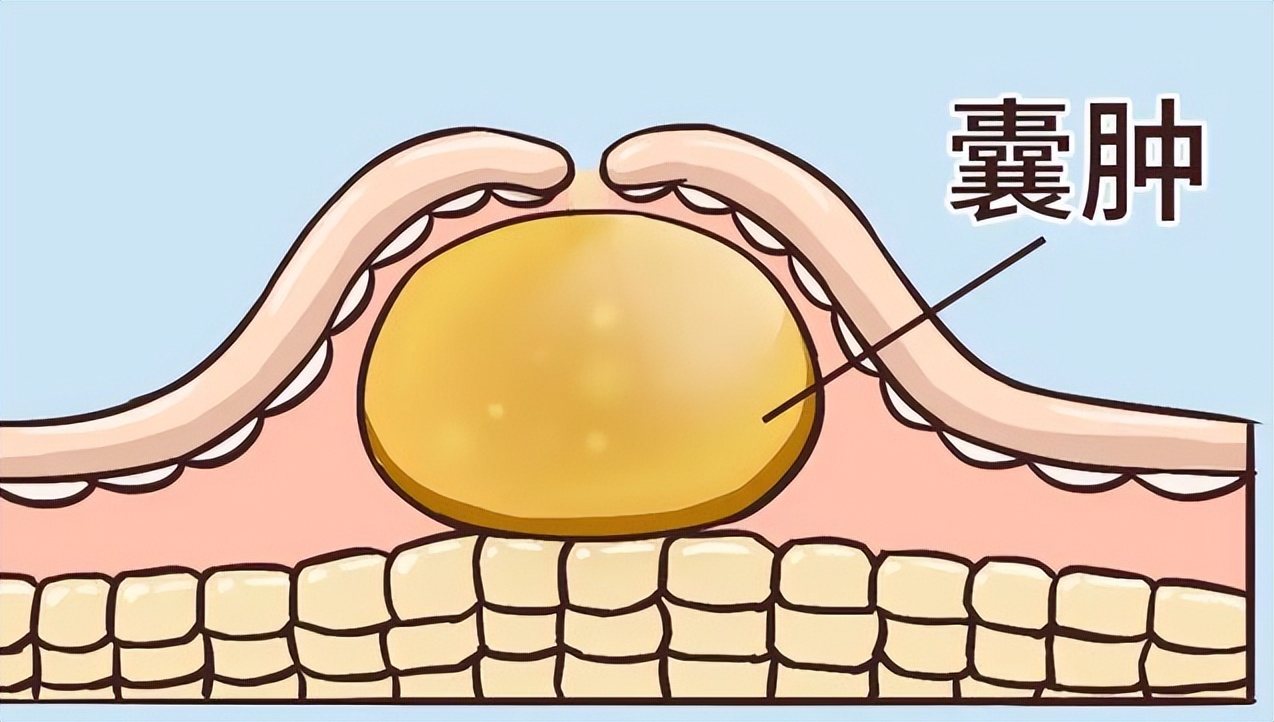 逍遥丸搭配什么治结节视频,逍遥丸配什么可以散结消囊肿