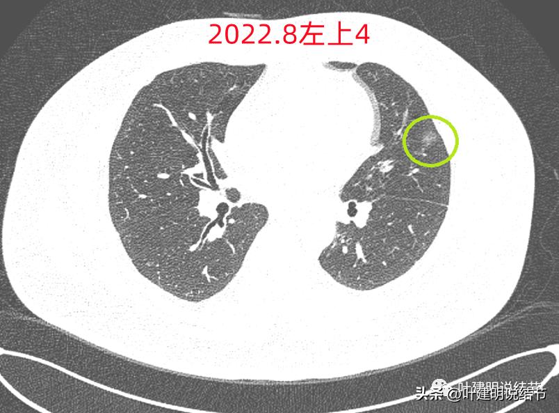 如何判断肺磨玻璃结节是高危结节,肺上有混合磨玻璃结节要注意什么