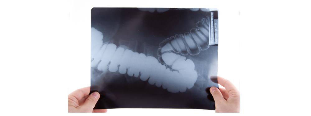 排便困难是肠道的原因,肠道菌群失调引起便秘怎么治