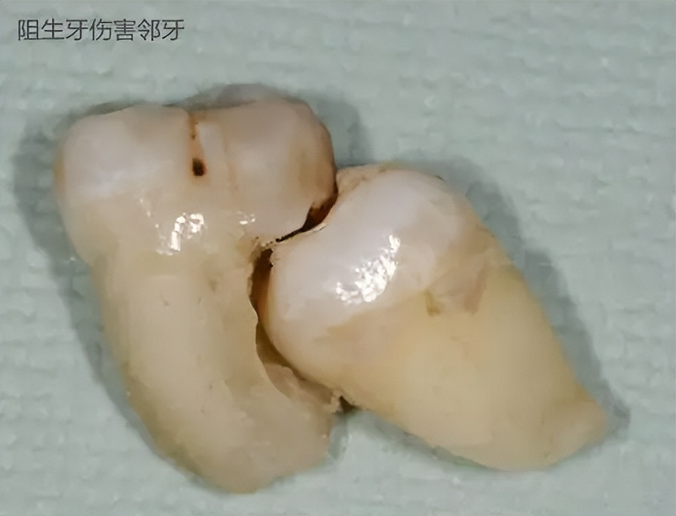 什么样的牙齿无药可救了,常见的牙齿的疾病和处理方法