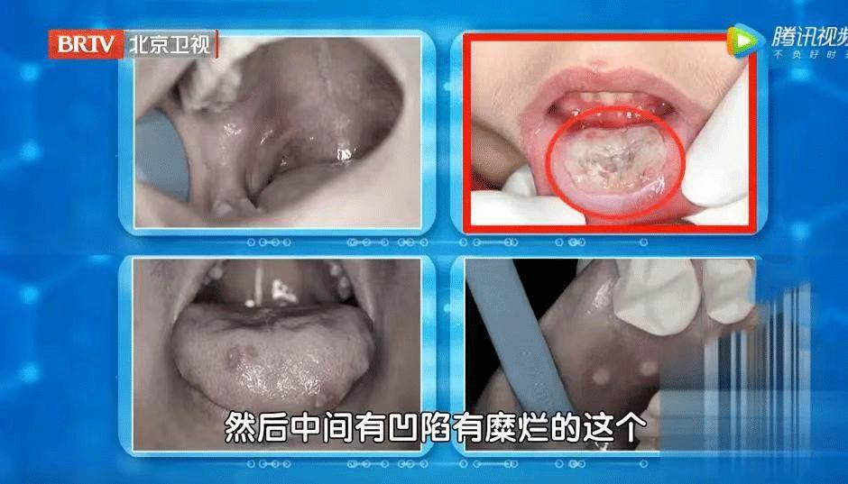 补充维生素c可以预防溃疡吗,溃疡吃维生素c可以吗