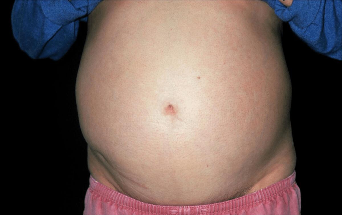 经常喝酒的人身体有什么表现,长期喝酒会得酒精肝吗