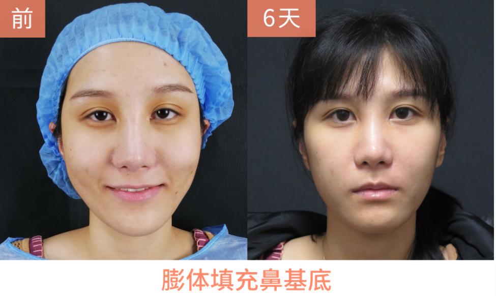 鼻基底少女针填充恢复过程,女25岁隆鼻术后七天全过程分享