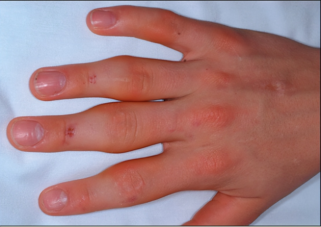 全球唯一可以治愈骨关节炎的药物,骨关节炎特效药最新研究