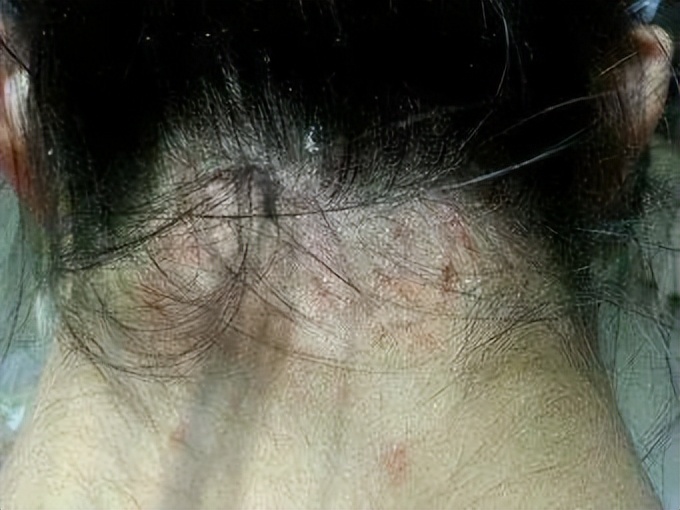 头皮上长疙瘩和脓包是怎么回事,头皮总是长疙瘩或脓包是什么原因