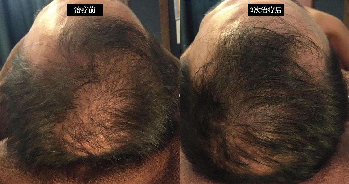 脱发根本就不能治,脱发治不了的视频