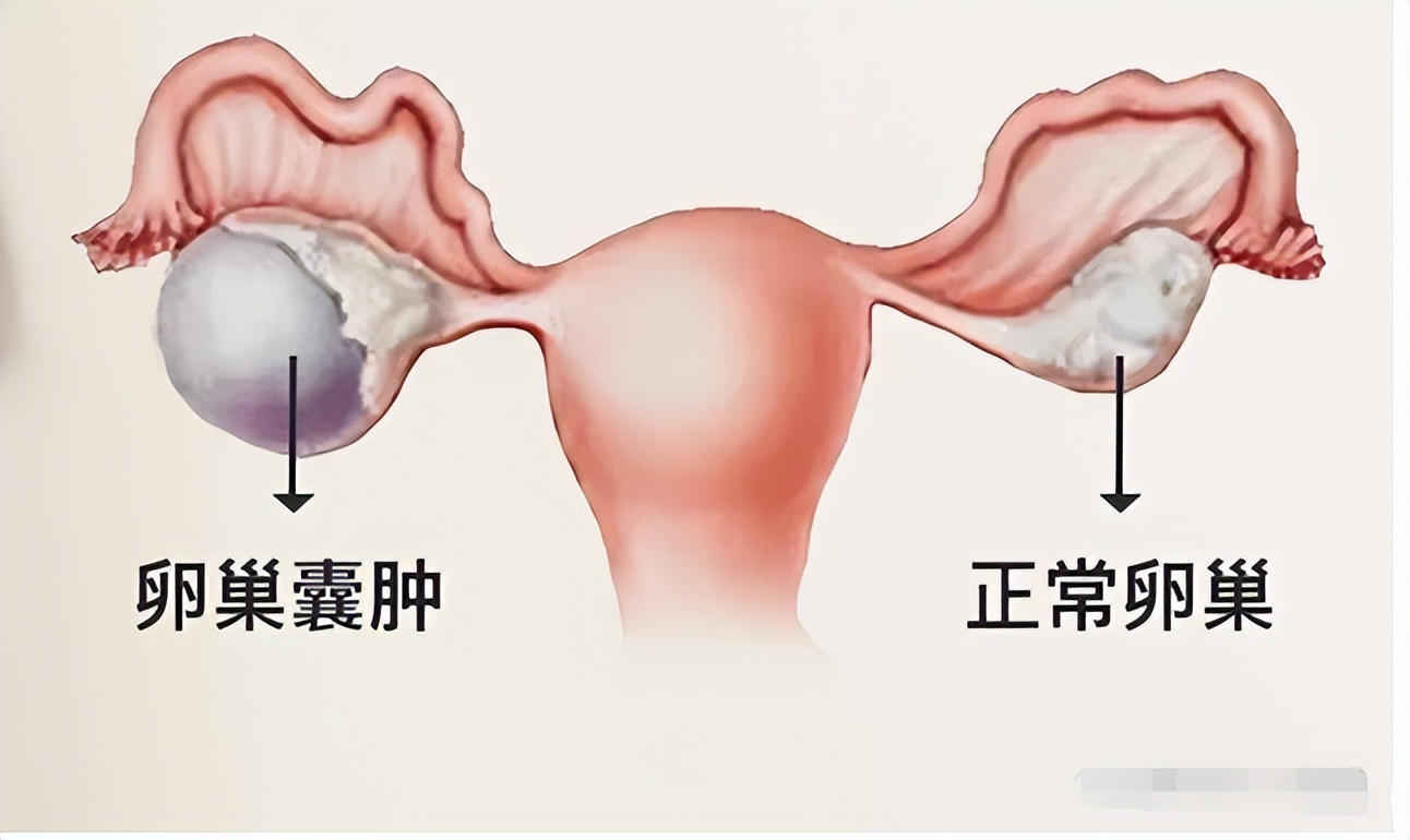 巧克力囊肿会导致哪些问题,巧克力囊肿为什么医生让尽快怀孕