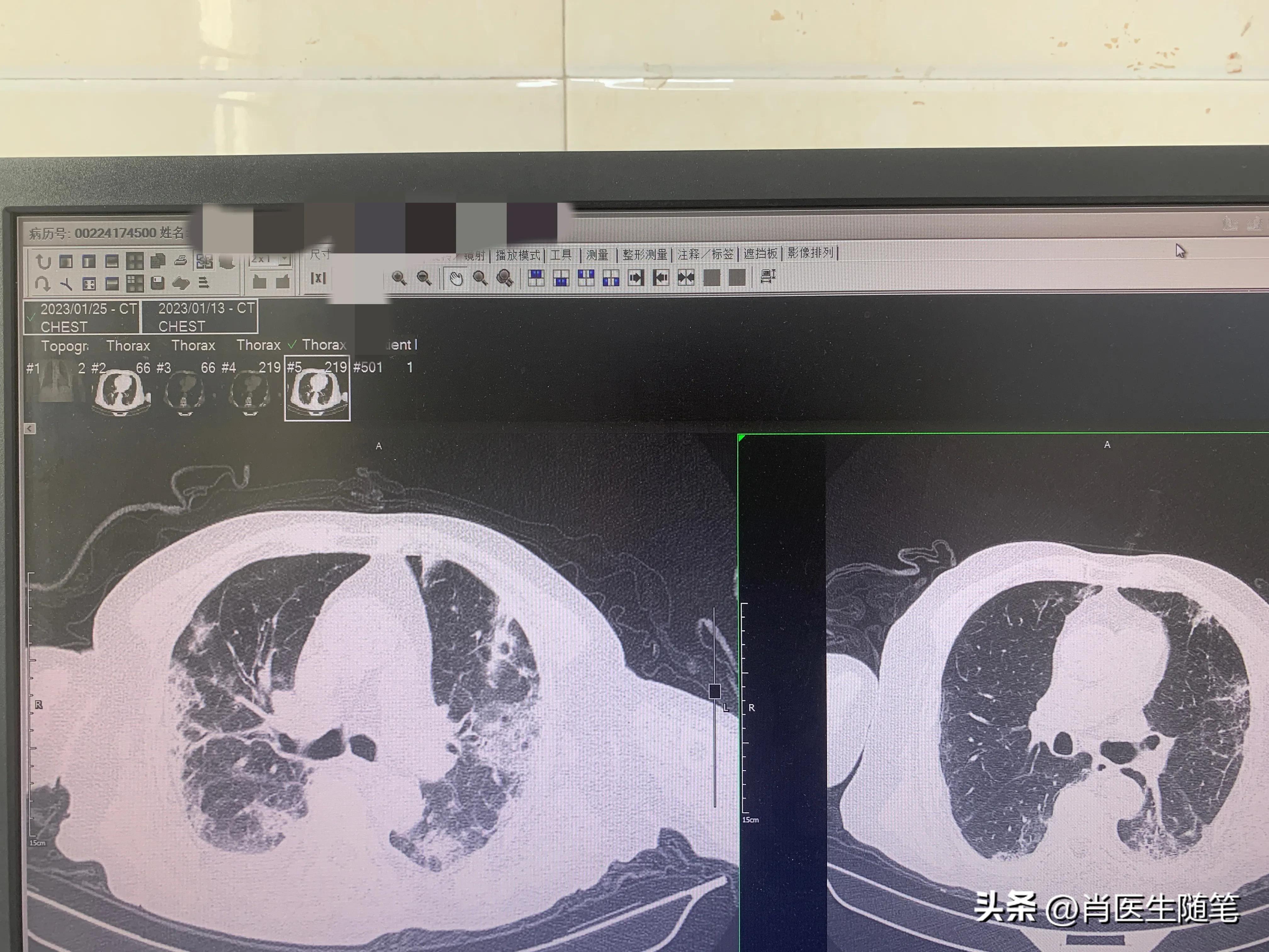84岁老人白肺治好了,86岁老人得了大白肺还有救吗