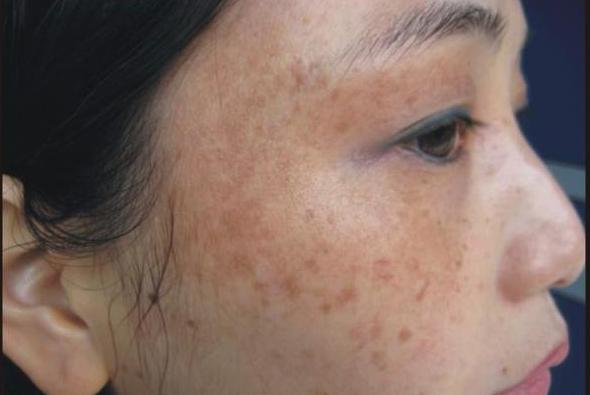 中药消除褐斑的方法是什么,中医怎么调理斑点皮肤暗黄