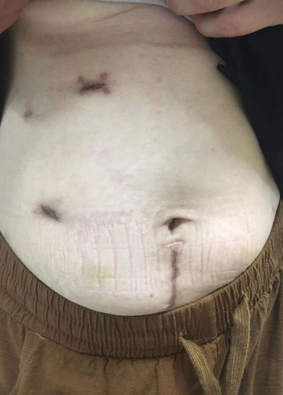 切口愈合不良多久能自愈,切口愈合不良的治疗方法