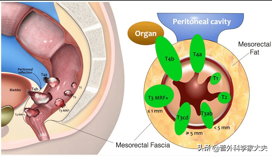 直肠腺癌术前化疗血常规,直肠癌t3m0n1术后最佳化疗方案