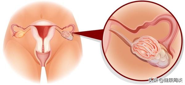 生理上长个囊肿怎么办,体检发现有囊肿怎么办