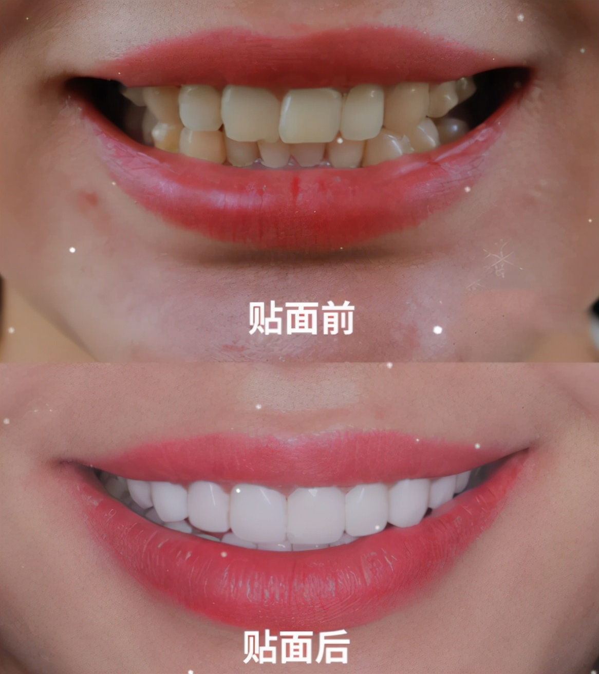 烤瓷牙好不舒服,烤瓷牙好不好看