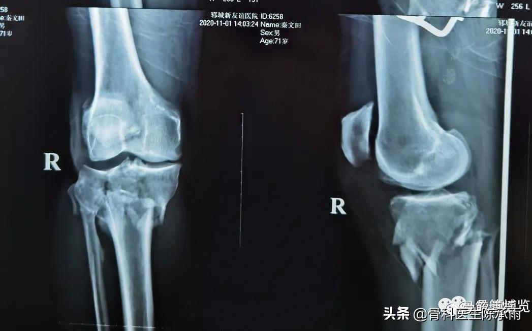 陈旧性腿骨骨折,陈旧性骨折