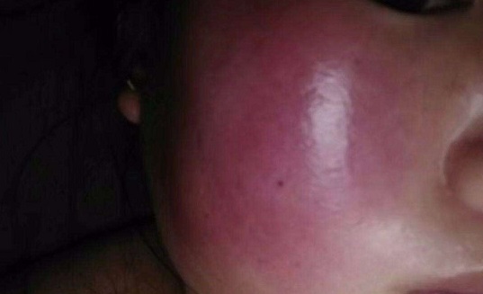 怎么修复脸部红血丝,怎么修复红血丝肌肤