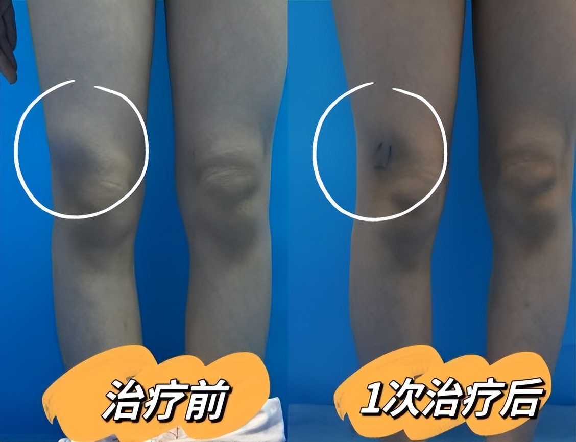 介入治疗淋巴管畸形的医学进展,淋巴管瘤有没有可能误诊